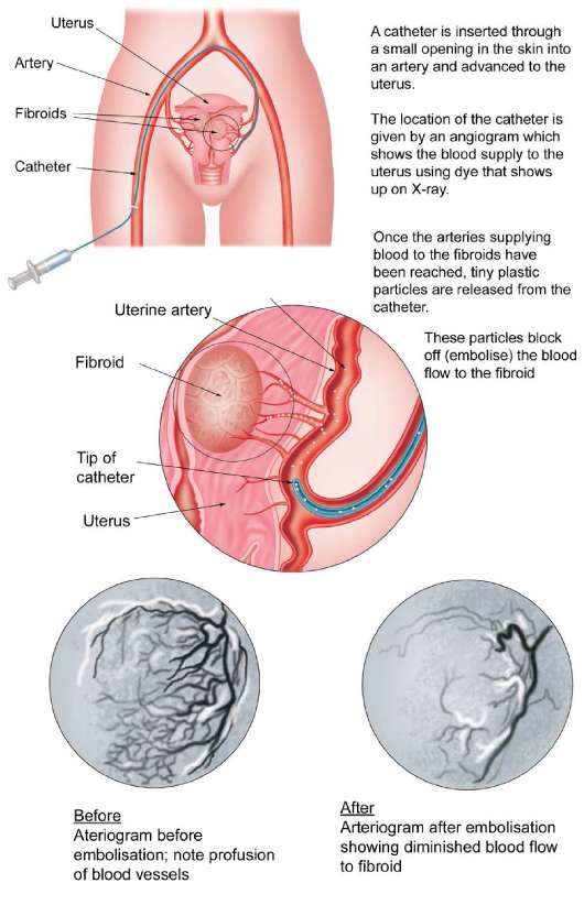 hysterectomy-21