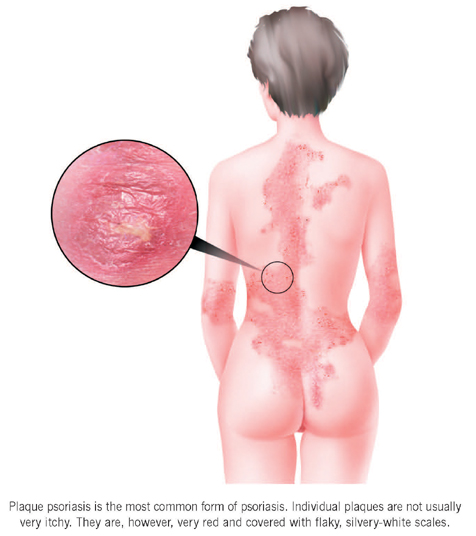 plaque psoriasis common areas)