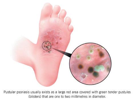 psoriasis on feet uk