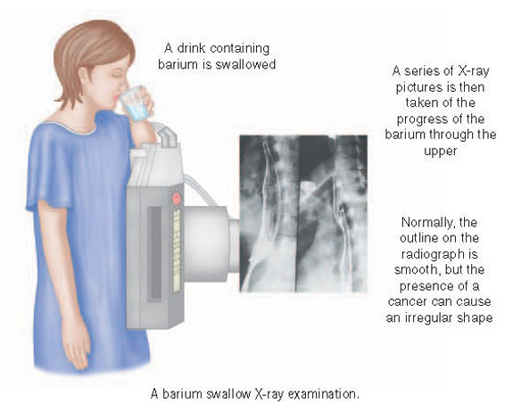 What is the barium swallow test used for?